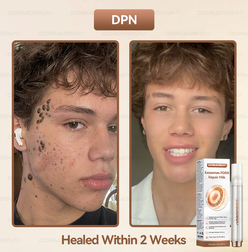 𝐎𝐟𝐟𝐢𝐜𝐢𝐚𝗜𝗜𝐲 𝐀𝐮𝐭𝐡𝐨𝐫𝐢𝐬𝐞𝐝 𝐄𝐱𝐜𝐥𝐮𝐬𝐢𝐯𝐞 𝐄𝐝𝐢𝐭𝐢𝐨𝐧 | 𝓓𝗢𝑹𝐌𝗢𝑹𝐍𝑨® 𝐄𝐱𝒐𝘀𝒐𝐦𝐞𝘀 𝐏𝐃𝐑𝐍 𝐑𝐞𝐩𝐚𝐢𝐫 𝐒𝐞𝐫𝐮𝐦🎗️𝐖𝐢𝐭𝐡 𝟐𝟎𝟎𝟎 𝐏𝐏𝐌 𝐄𝐱𝐨𝐬𝐨𝐦𝐞-𝐜𝐨𝐚𝐭𝐞𝐝 𝐒𝐩𝐢𝐜𝐮𝗹𝐞𝐬