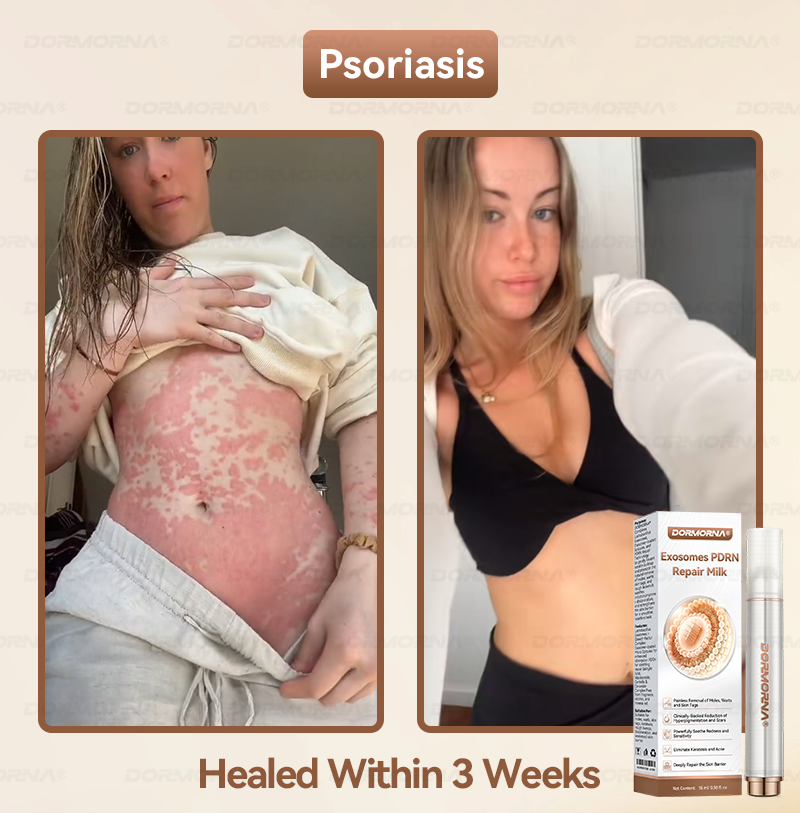 𝐎𝐟𝐟𝐢𝐜𝐢𝐚𝗜𝗜𝐲 𝐀𝐮𝐭𝐡𝐨𝐫𝐢𝐬𝐞𝐝 𝐄𝐱𝐜𝐥𝐮𝐬𝐢𝐯𝐞 𝐄𝐝𝐢𝐭𝐢𝐨𝐧 | 𝓓𝗢𝑹𝐌𝗢𝑹𝐍𝑨® 𝐄𝐱𝒐𝘀𝒐𝐦𝐞𝘀 𝐏𝐃𝐑𝐍 𝐑𝐞𝐩𝐚𝐢𝐫 𝐒𝐞𝐫𝐮𝐦🎗️𝐖𝐢𝐭𝐡 𝟐𝟎𝟎𝟎 𝐏𝐏𝐌 𝐄𝐱𝐨𝐬𝐨𝐦𝐞-𝐜𝐨𝐚𝐭𝐞𝐝 𝐒𝐩𝐢𝐜𝐮𝗹𝐞𝐬
