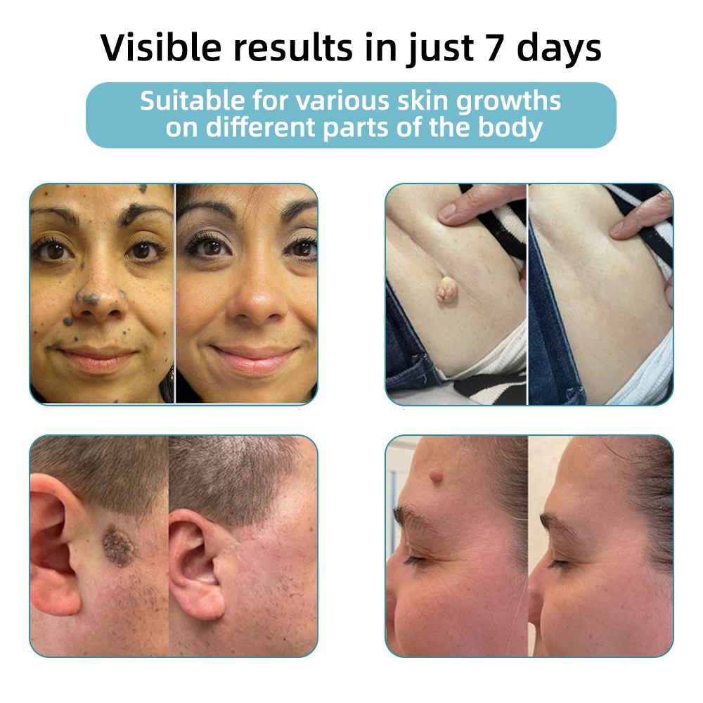 Total Skin Confidence Starts Here✨𝗞ı𝗱s𝗻𝗲𝗲𝗱® 𝗡𝗼𝗻-𝗜𝗻𝘃𝗮𝘀𝗶𝘃𝗲 𝗠𝗼𝗜𝗲 𝗮𝗻𝗱 𝗪𝗮𝗿𝘁 𝗥𝗲𝗺𝗼𝘃𝗮𝗜 𝗜𝗮𝘀𝗲𝗿 𝗣𝗲𝗻👨‍⚕️