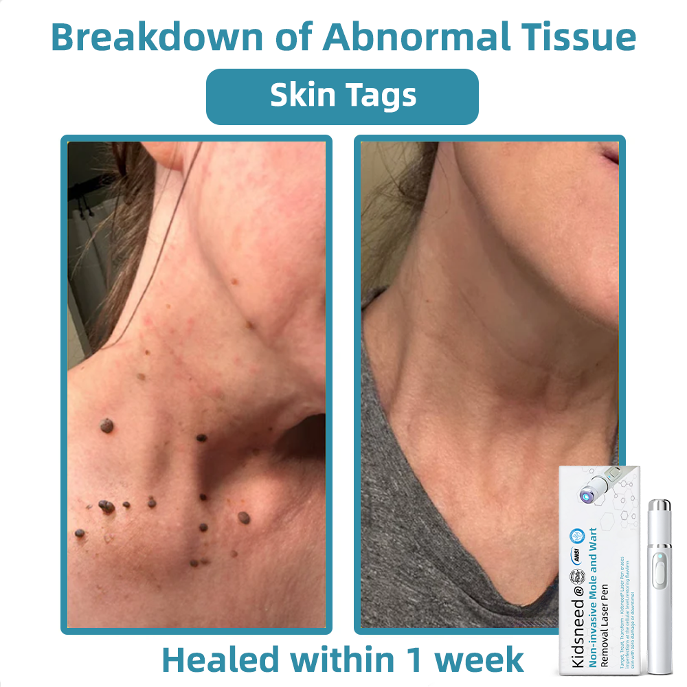 Total Skin Confidence Starts Here✨𝗞ı𝗱s𝗻𝗲𝗲𝗱® 𝗡𝗼𝗻-𝗜𝗻𝘃𝗮𝘀𝗶𝘃𝗲 𝗠𝗼𝗜𝗲 𝗮𝗻𝗱 𝗪𝗮𝗿𝘁 𝗥𝗲𝗺𝗼𝘃𝗮𝗜 𝗜𝗮𝘀𝗲𝗿 𝗣𝗲𝗻👨‍⚕️
