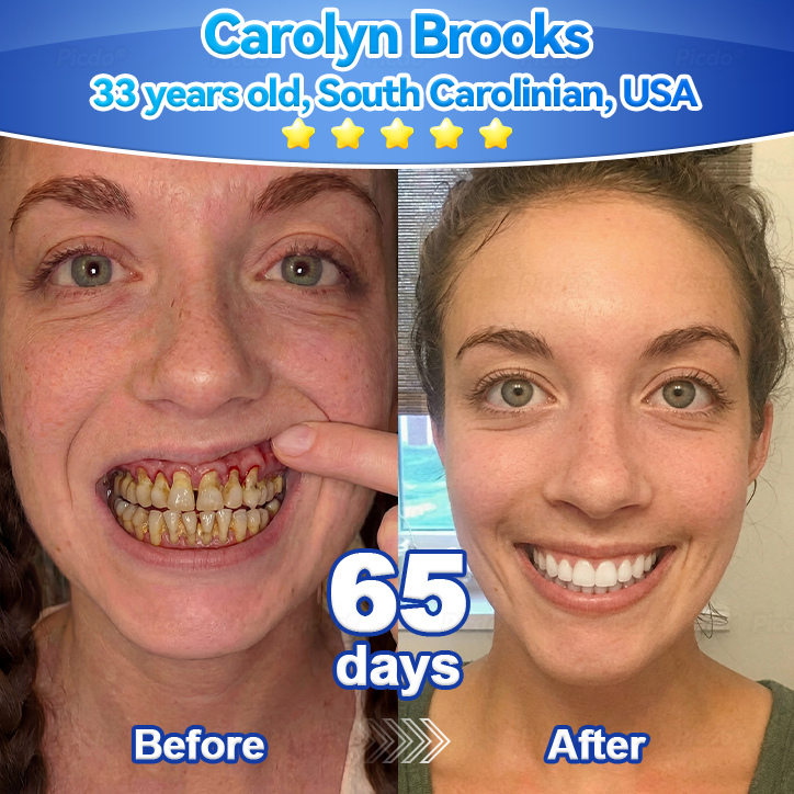 𝑃𝑖𝑐𝑑𝑜® 𝑆𝑡𝑒𝑚 𝐶𝑒𝑙𝑙 𝐺𝑖𝑛𝑔𝑖𝑣𝑎𝑙 𝑅𝑒𝑝𝑎𝑖𝑟 𝑀𝑜𝑢𝑠𝑠𝑒👩‍⚕️(Promote Tooth Regrowth • Remove Tartar • Strengthen Gums • Deep Clean & Freshen Breath) 🦷