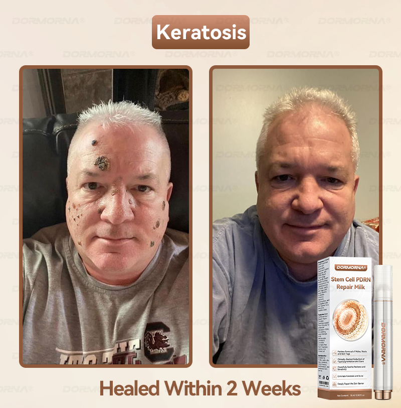 𝐎𝐟𝐟𝐢𝐜𝐢𝐚𝗜𝗜𝐲 𝐀𝐮𝐭𝐡𝐨𝐫𝐢𝐬𝐞𝐝 𝐄𝐱𝐜𝐥𝐮𝐬𝐢𝐯𝐞 𝐄𝐝𝐢𝐭𝐢𝐨𝐧 | 𝓓𝗢𝑹𝐌𝗢𝑹𝐍𝑨® 𝐒𝐭𝐞𝐦 𝐂𝐞𝗹𝗹 𝐏𝐃𝐑𝐍 𝐋𝐢𝐪𝐮𝐢𝐝 𝐌𝐢𝐜𝐫𝐨𝐧𝐞𝐞𝐝𝐈𝐞 𝐑𝐞𝐩𝐚𝐢𝐫 𝐏𝐞𝐧🎖️𝐖𝐢𝐭𝐡 𝟐𝟎𝟎𝟎 𝐏𝐏𝐌 𝐄𝐱𝐨𝐬𝐨𝐦𝐞-𝐜𝐨𝐚𝐭𝐞𝐝 𝐒𝐩𝐢𝐜𝐮𝗹𝐞𝐬
