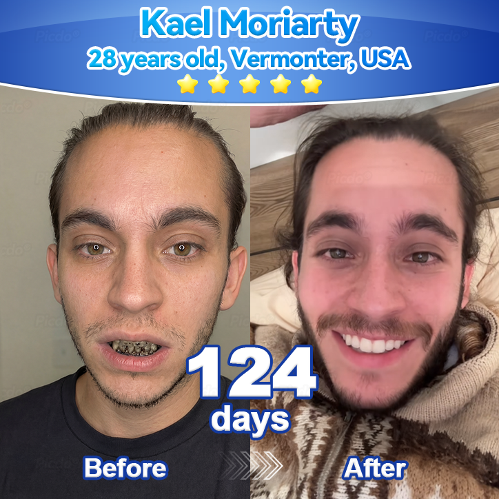 𝑃𝑖𝑐𝑑𝑜® 𝑆𝑡𝑒𝑚 𝐶𝑒𝑙𝑙 𝐺𝑖𝑛𝑔𝑖𝑣𝑎𝑙 𝑅𝑒𝑝𝑎𝑖𝑟 𝑀𝑜𝑢𝑠𝑠𝑒👩‍⚕️(Promote Tooth Regrowth • Remove Tartar • Strengthen Gums • Deep Clean & Freshen Breath) 🦷